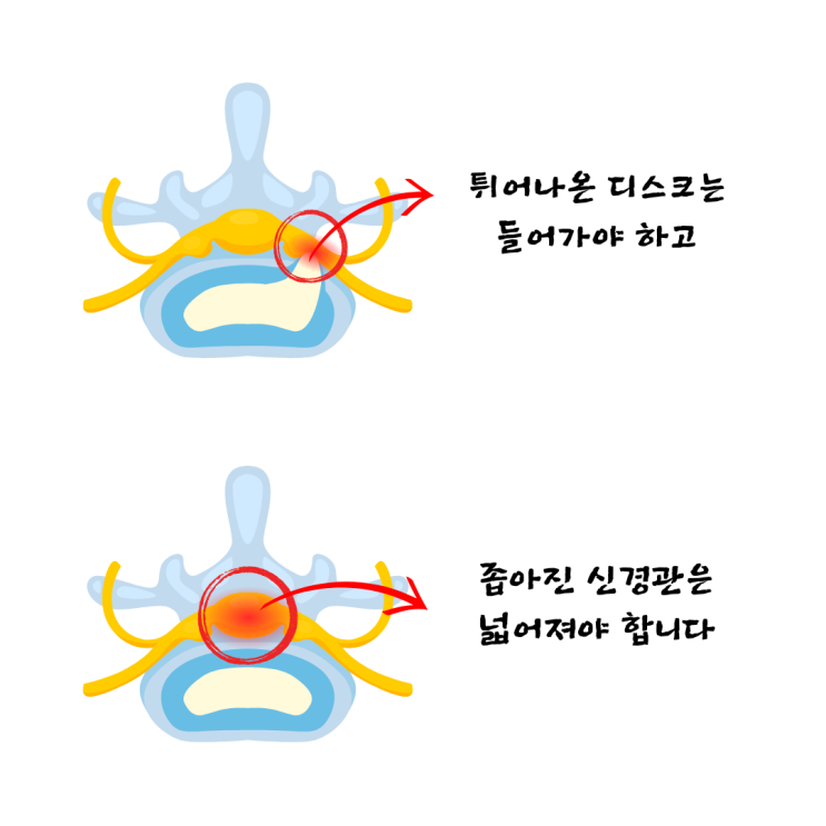  디스크, 협착증 시술하고 수술해도 재발하는 이유 (1/2)
