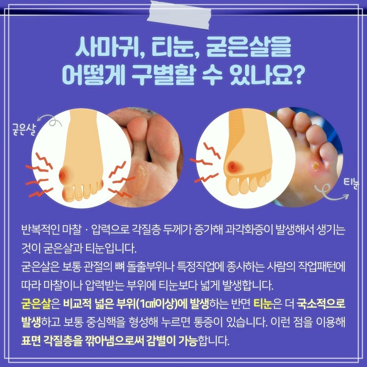 티눈 생기는 이유 제거 방법과 사마귀와 구분
