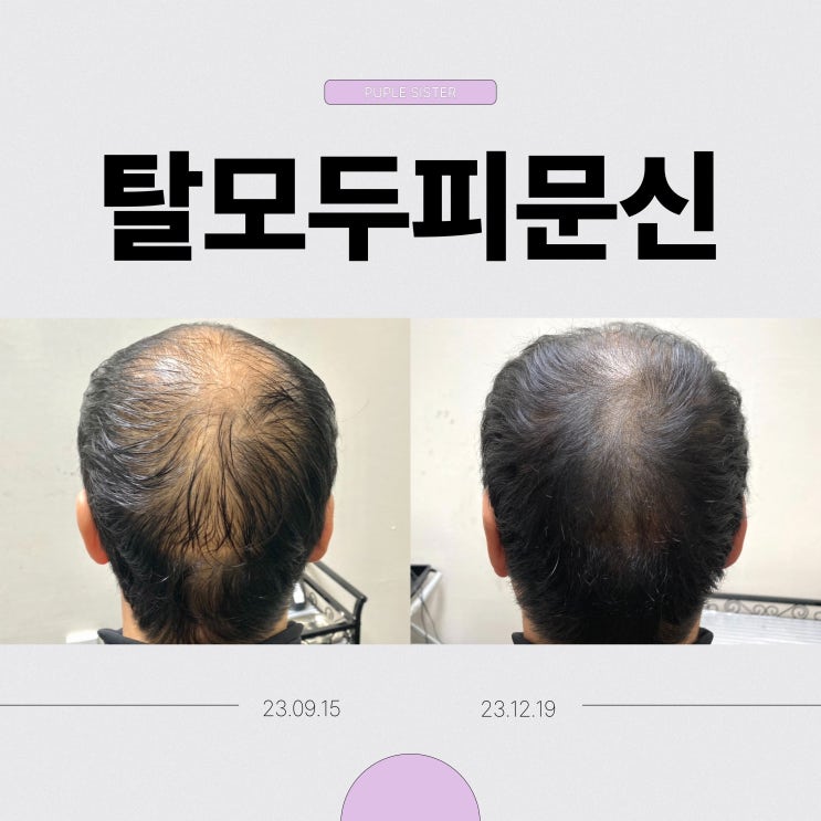  일산두피문신, 진짜 티 안 나게 할 수 있을까? 궁금증을 풀어드립니다!