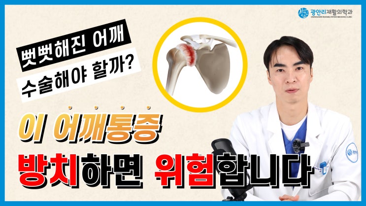  수영역정형외과 어깨통증 방치하면 위험! 오십견이라 불리는 동결견 완전 정리