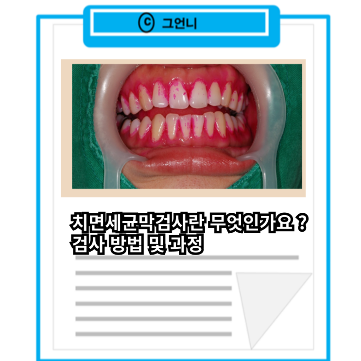 치면세균막검사란 무엇인가요 형성과정 착색제 검사방법