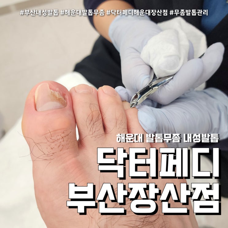  부산 해운대 발톱무좀 (feat. 닥터페디 해운대장산점 )
