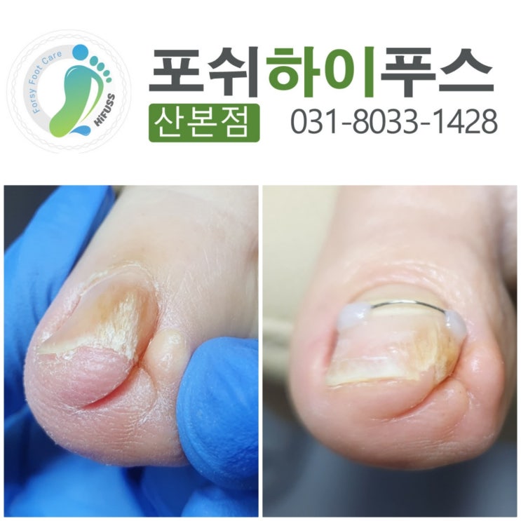  산본내성발톱 교정과 무좀 관리, 믿고 찾는 '포쉬 하이푸스 산본점'