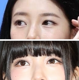 <b>수지</b> 눈동자 점 <b>제거</b>? 전후 및 <b>결막모반</b> 원인
