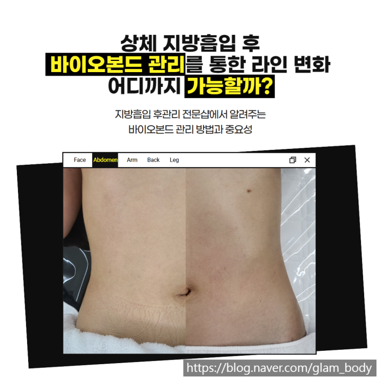 상체지방흡입 바본 관리를 통한 라인 변화 전/후 차이