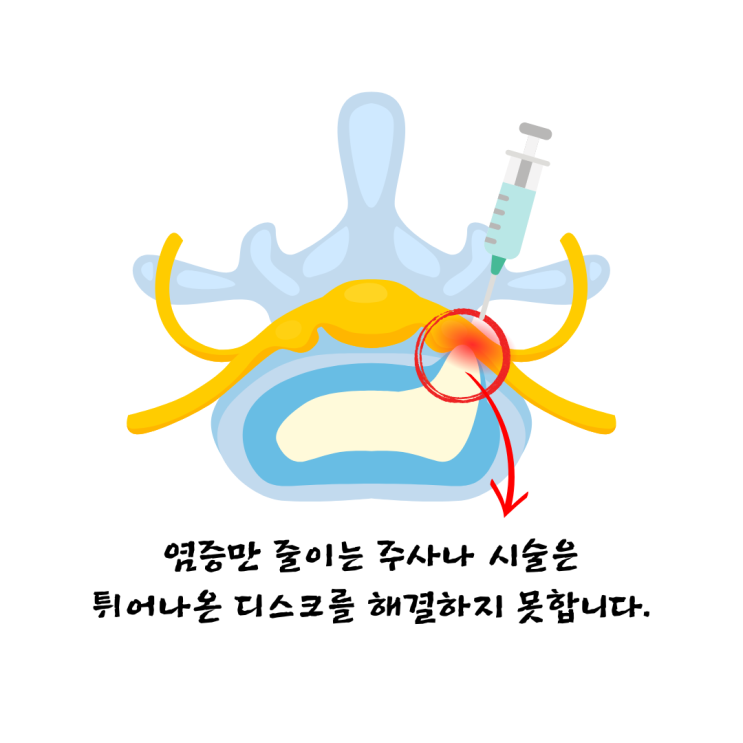  수영역한의원, 허리디스크 '이것'만 알면 수술 안 합니다.