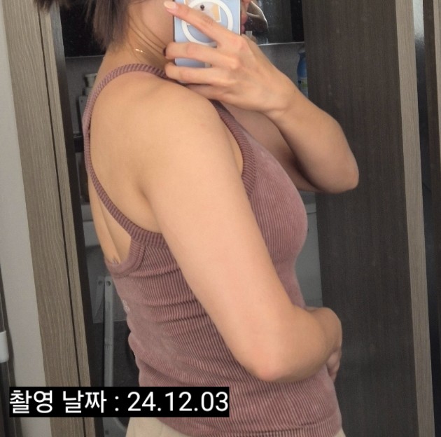 부산 팔뚝 지방분해주사 내돈내산 가격 2회차 후기