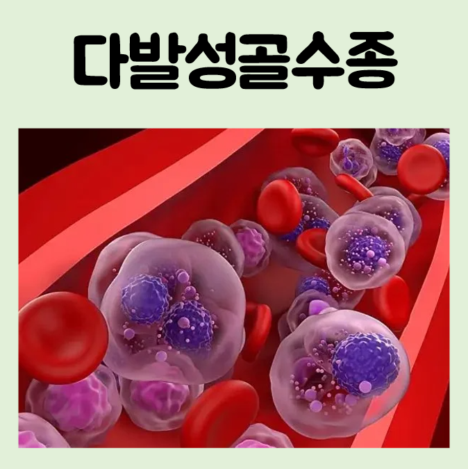 다발성 골수종 생존율 예후 multiple myeloma 진단 치료