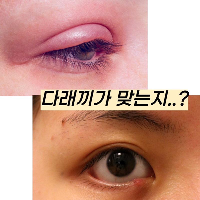 대전다래끼? 안과에 꼭 가야 할지 고민이셨다면