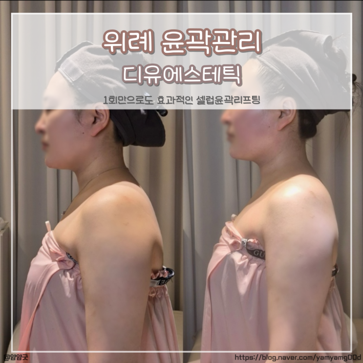  위례피부관리 추천 - 디유에스테틱 위례윤곽관리 후기 (셀럽윤곽리프팅)
