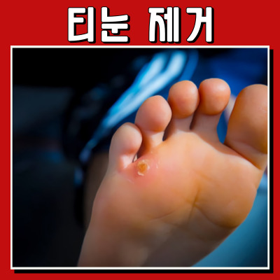 발바닥 티눈 제거법과 예방법