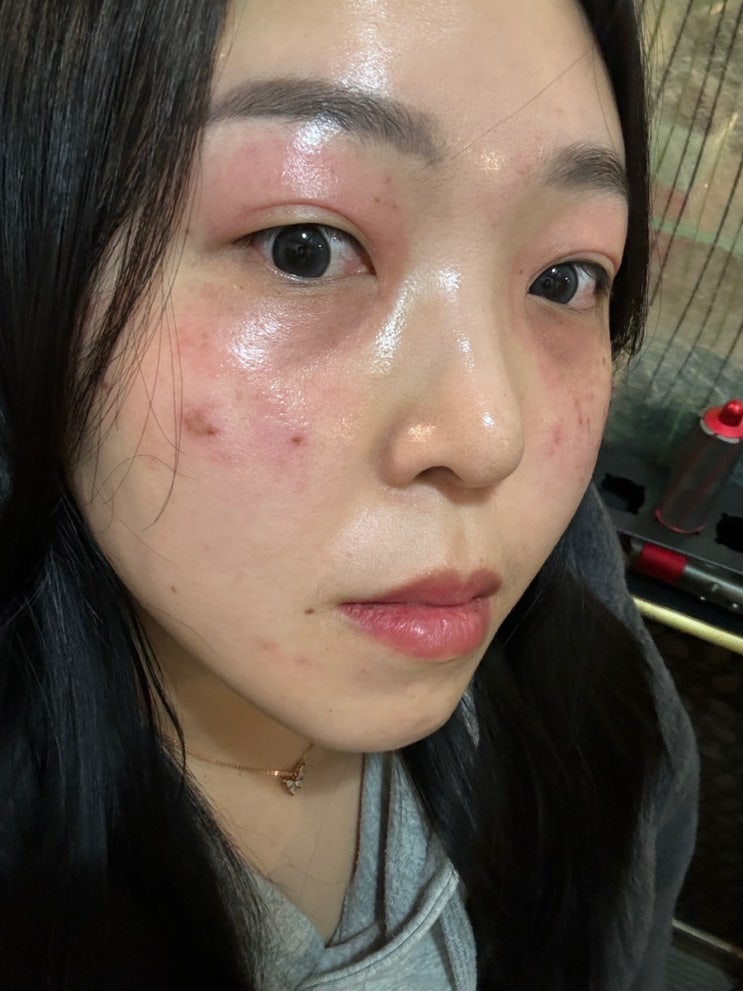  운정 피부관리 와이제이뷰티 콜드플라즈마 기미 변화 후기