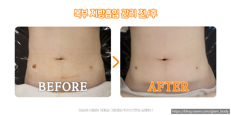  복부지방흡입 붓기와 바이오본드 관리 전후 차이