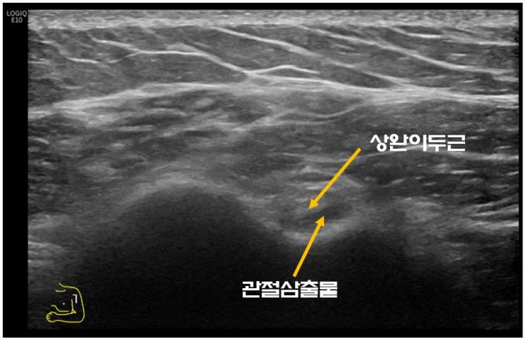  광주 오십견, 어깨통증증상 계속 지속되어 광주까지?