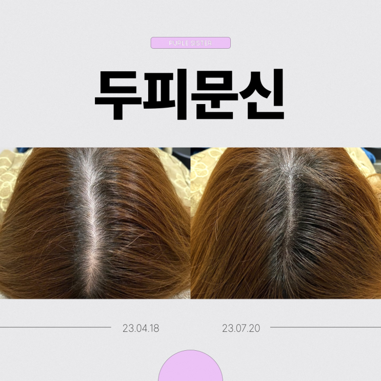  인천피부과 두피문신은 영구일까? 반영구일까?