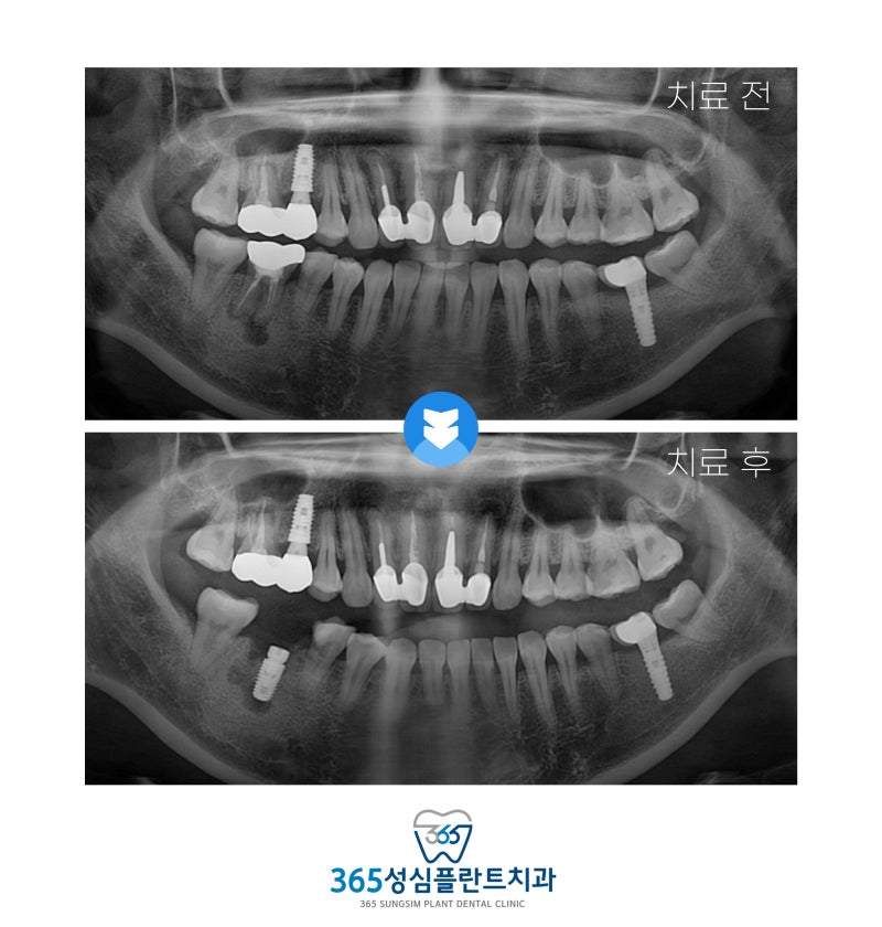대전일요일치과, 주말에도 임플란트 가능한가요?