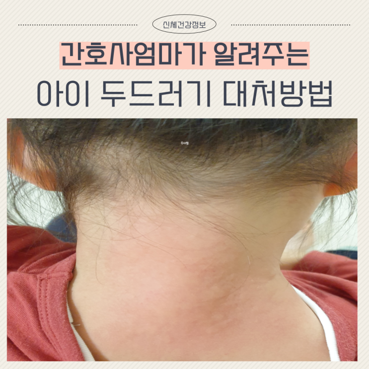  아이 두드러기 약 없을때 대처방법