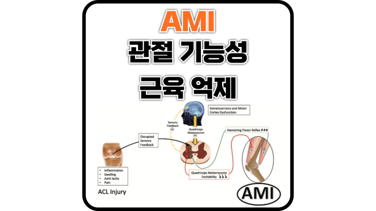  무릎 수술 후 허벅지가 얇아지는 이유(관절 기인성 근육 억제 Arthrogenic muscle inhibition, AMI)