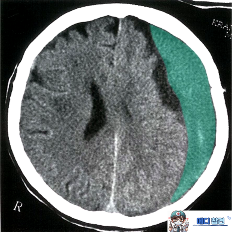 경막하 출혈 Subdural Hemorrhage SDH 의학용어 급성 외상성 : 네이버 블로그