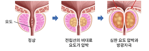 전립선 비대증 원인, 증상/합병증, 진단, 치료, 예방방법, 좋은 음식, 좋지 않은 음식