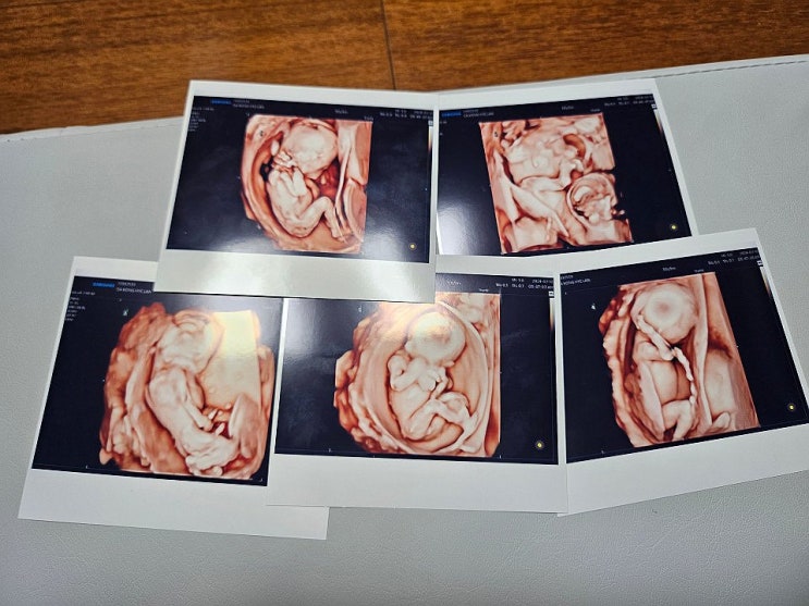 "오둥이 넷째 다섯째 수술, 이젠 걱정보다 행복…多태아보험 아쉬워" "오둥이 넷째 다섯째 수술, 이젠 걱정보다 행복…多태아보험 아쉬워"