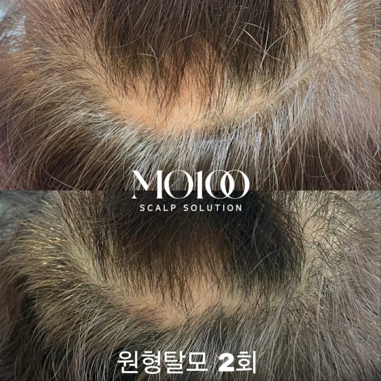  ️원형탈모 스트레스️ 문현동 탈모관리 주르 에스테틱