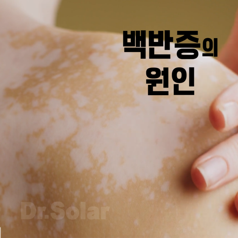 백반증 유전인가요? 원인에 대해 알아봅시다