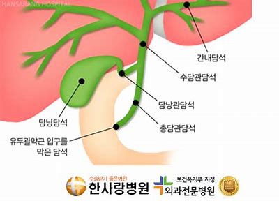 담낭염이란!?