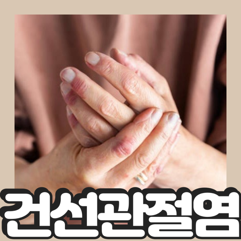 건선관절염 완화 및 관리방법
