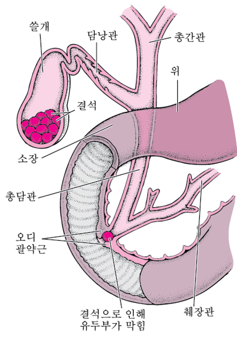 담석(담석증)이란