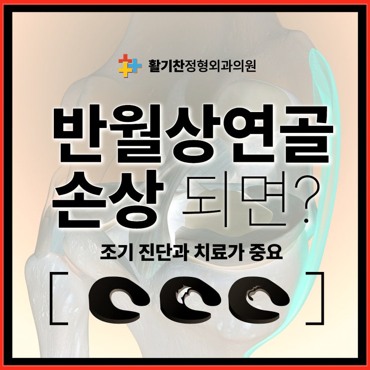  갈현동정형외과, 무릎 잠김 현상과 반월상 연골 손상 예방치료