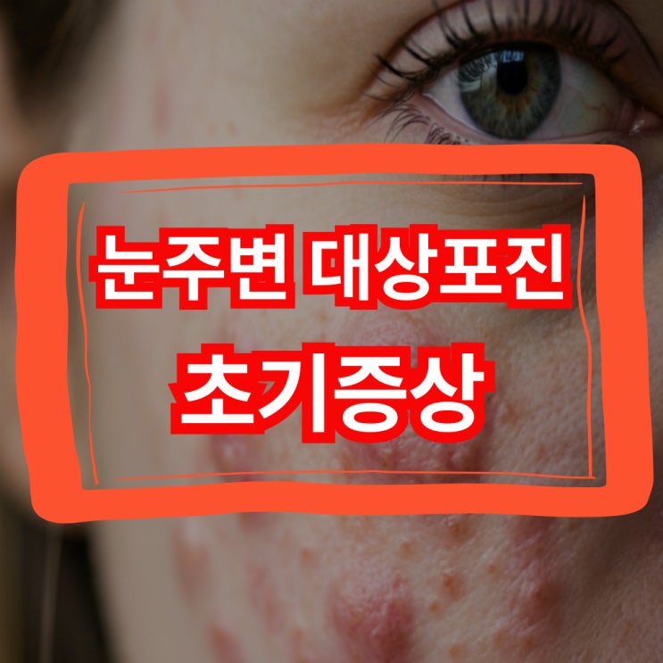  눈주변 대상포진 초기증상 '1분만에' 알려드릴게요