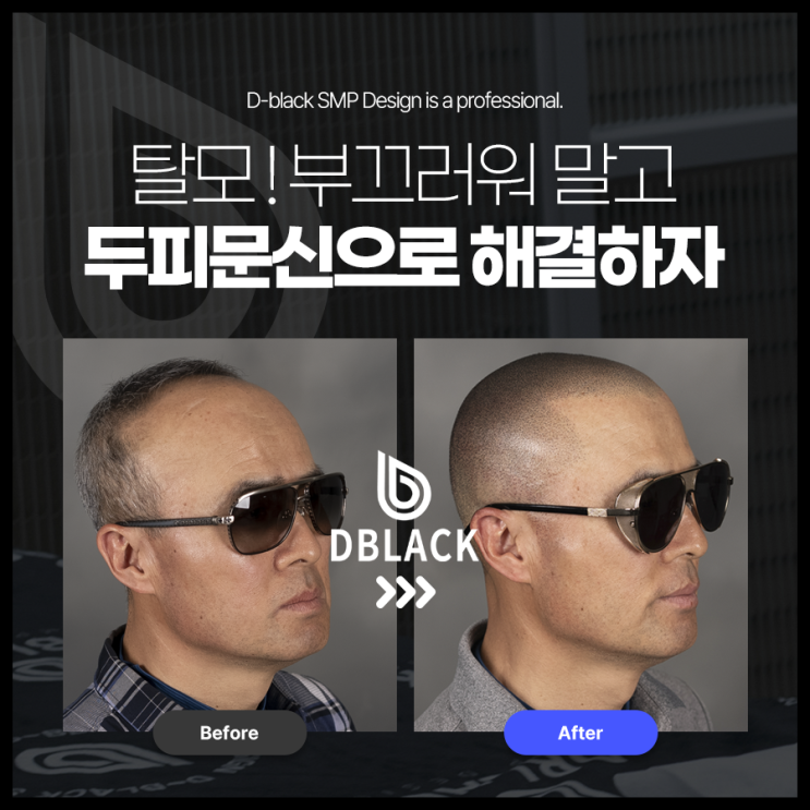  탈모의 원인과 해결방안, 나도 모르게 탈모가 되고 있다!