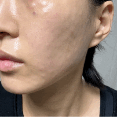  강남 피부과 리쥬란힐러 효과 2cc 가격 통증 전후 비교 후기