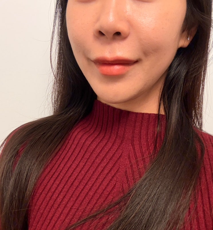  명동피부과 리프팅레이저 리니어지후기 땅콩형얼굴 리니어지 직후 효과