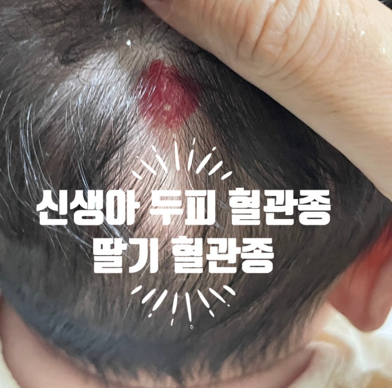 신생아 두피혈관종 딸기혈관종