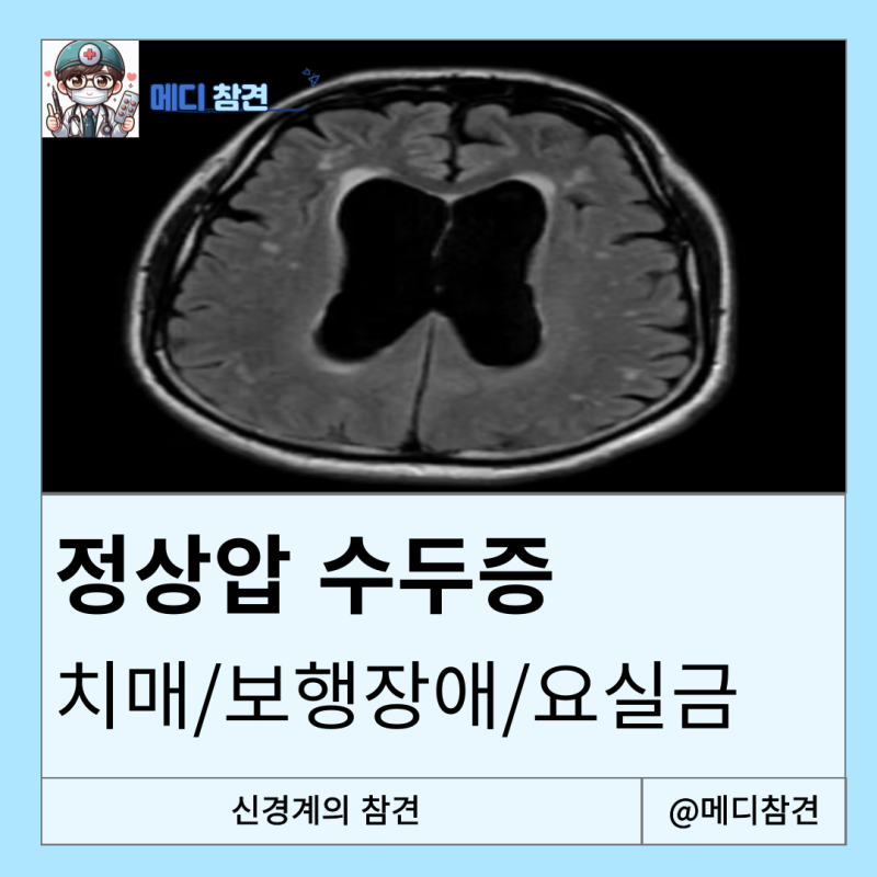 정상압 수두증 NPH Dementia Gait Disturbance Urinary Incontinence 의학용어