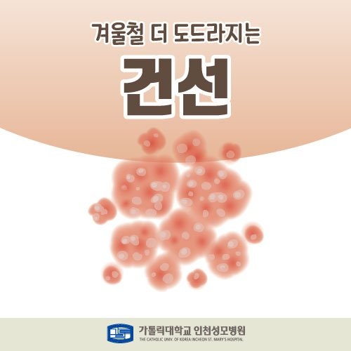 [피부과 김혜성 교수] 겨울철 더 도드라지는 '건선' 치료법