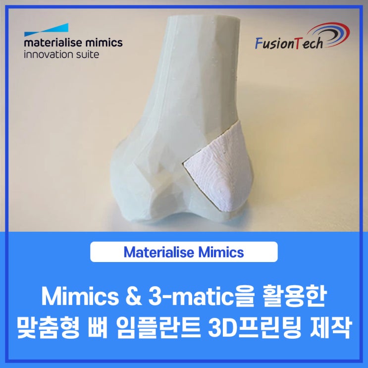  [Materialise S/W] 흡수성 바이오 잉크 스타트업이 3D프린팅으로 환자별 맞춤형 뼈 임플란트를 제작하는 방법