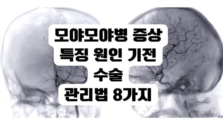  모야모야병 증상 특징 원인 기전 수술 관리법 8가지