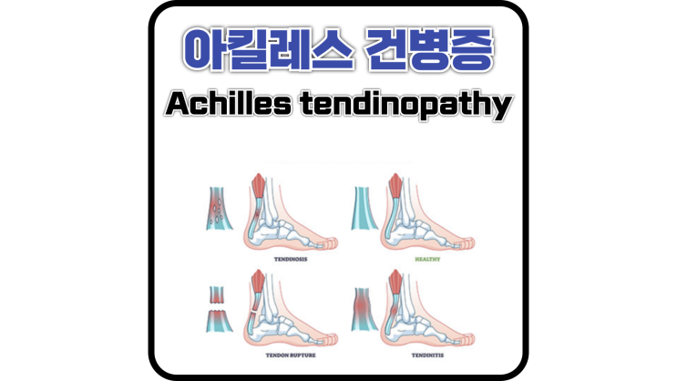  아킬레스 건병증 너 뭐야?