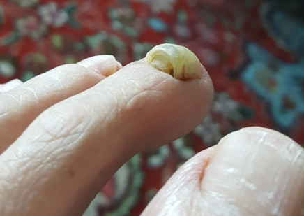  청주 발톱 뿌리가 아파요