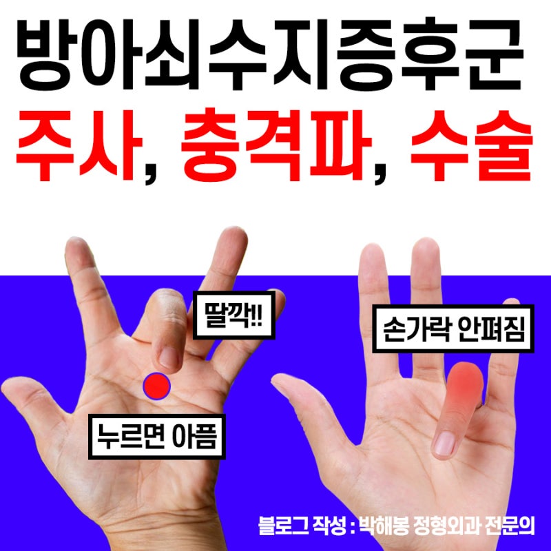 방아쇠수지증후군 주사, 수술 (병원 치료)