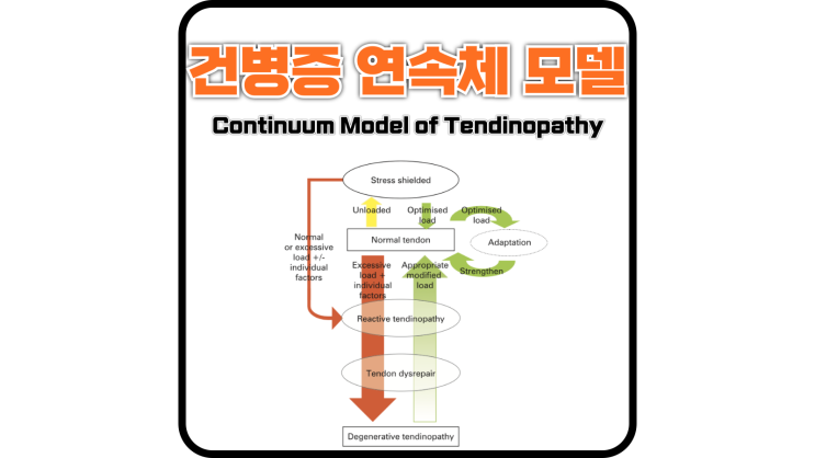  Continuum Model of Tendinopathy(건, 힘줄 연속체 모델) / 아킬레스건병증, 슬개 건병증 건병증 너 뭐야