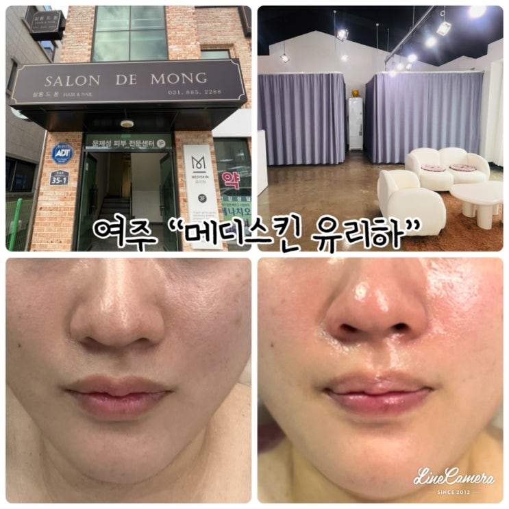  여주피부관리 "메디스킨 유리하" 에너지테라피와 모공관리등 받고온후기