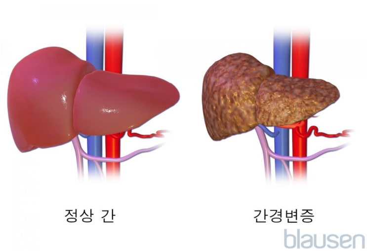 간 질환 - 간경변증