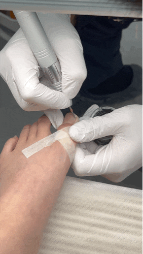  [세종: 나성동] 세종 내성발톱 관리 가격 통증 후기 “세종이엠 문제성손발톱클리닉”