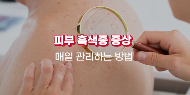 피부 흑색종 증상 초기 관리 이렇게