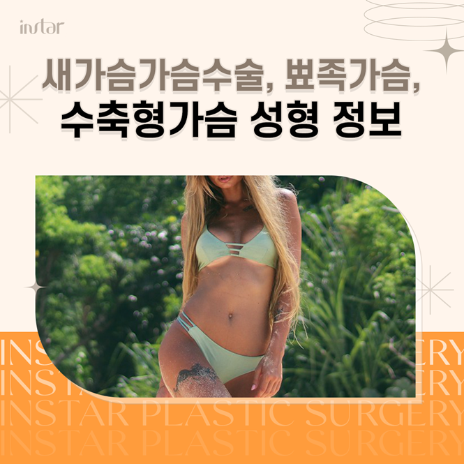  뾰족가슴, 수축형가슴,새가슴가슴수술 성형 정보