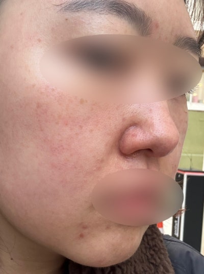 신논현역 스킨부스터 리쥬란힐러 4cc  손주사 + 7일 경과까지의 현실 솔직 후기